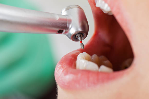 Best Emergency Wisdom Tooth Extraction in Louisville, NE